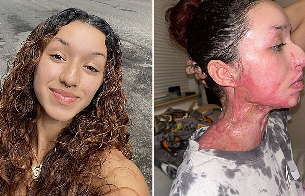 Útočník ve fitku polil ženu kyselinou, o život v nemocnici bojovala týdny